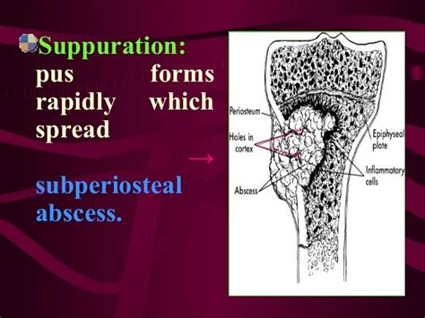 Bone and Joint Infection