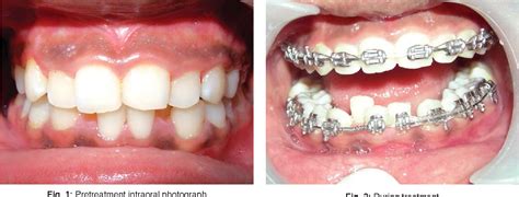 Figure 4 From Therapeutic Extraction Of Lower Incisor For Orthodontic