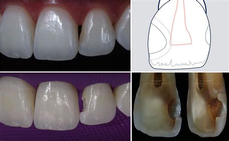 Pulpotomia De Dentes Permanentes