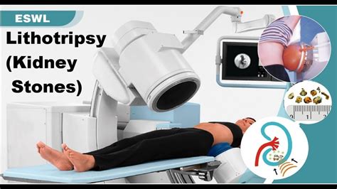 What Is Laser Lithotripsy For Kidney Stones At Isidro Branham Blog