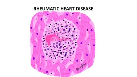 Pathophysiology Of Rheumatic Fever