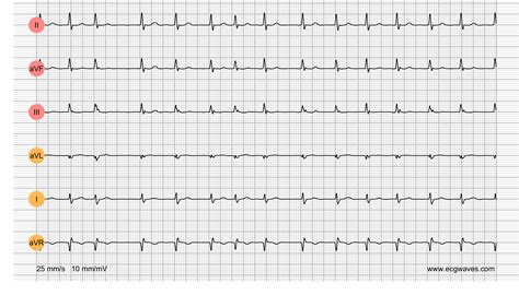 Ecg Test Library Quiz 2 Kardiovaskuläre Medizin Online