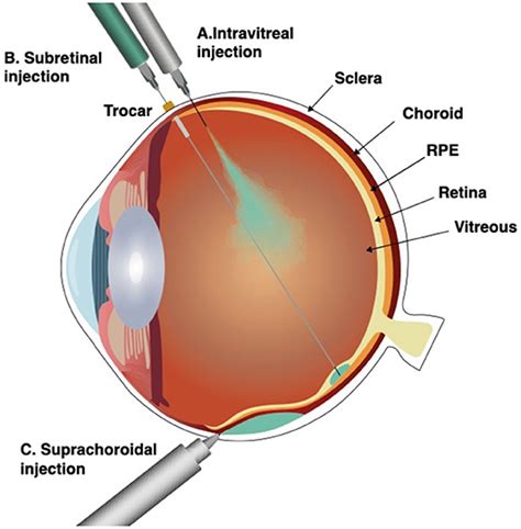 Frontiers Subretinal Therapy Technological Solutions To Surgical And