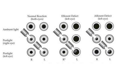 Perrla Eye Test