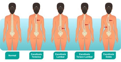 La Escoliosis Descripci N Causas Y S Ntomas Yogaprem