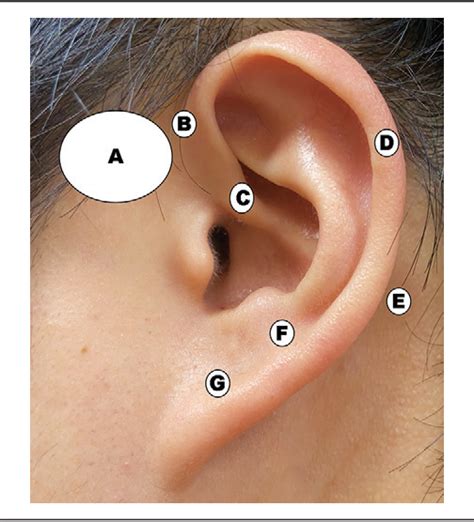 Figure 1 From The Differences Between 2 Cases Of Preauricular Fistula