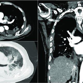 A 79-year-old man underwent surgery for a right abscess as a ...