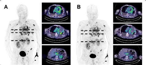 Whole Body Pet Ct Images Of A Y Old Patient With Nsclc In The Left