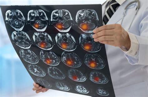 ¿qué Es Un Accidente Cerebrovascular Acv Filo News