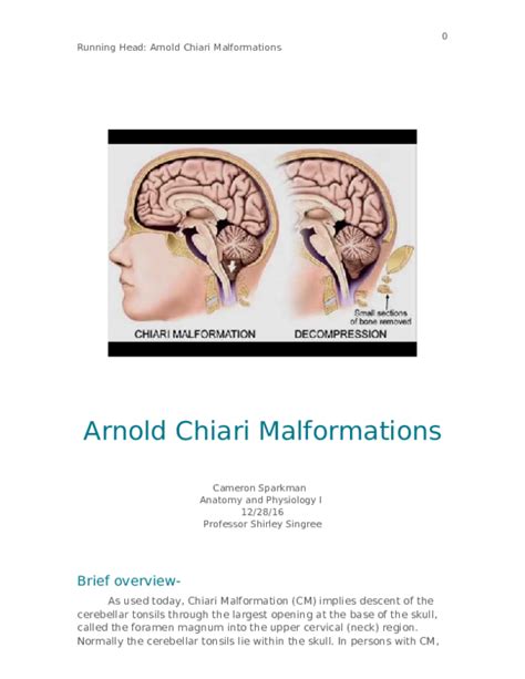 Arnold Chiari Malformation Diagram