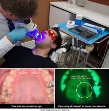 Oral Cancer Awareness The Importance Of Velscope Exam Routine Dental