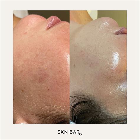 Microneedling And Hydrafacial The Perfect Duo Skn Bar Rx