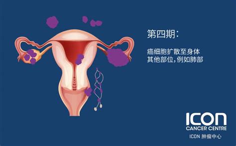 Ovarian Cancer Signs Symptoms Icon Centre Singapore