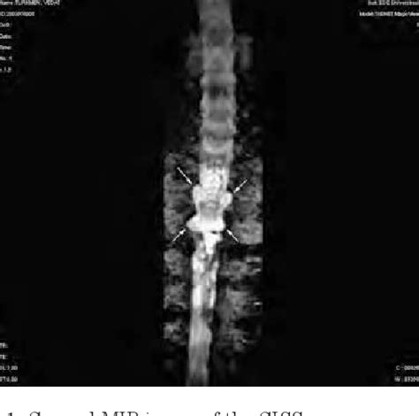 Figure From Traumatic Nerve Root Avulsion And Pseudomeningocele