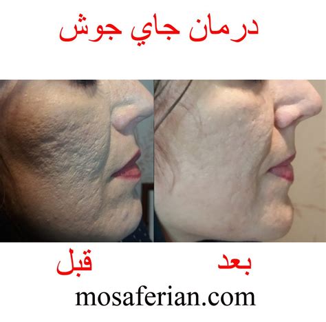 laser treatment for acne scars