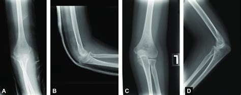 (A) Radiograph showing the right elbow after reduction and external... | Download Scientific Diagram