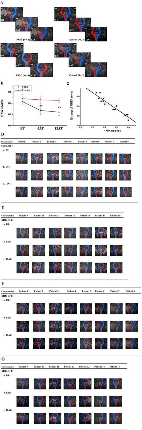 Representative temporal changes of tractography in MRI-DTI. (A ...