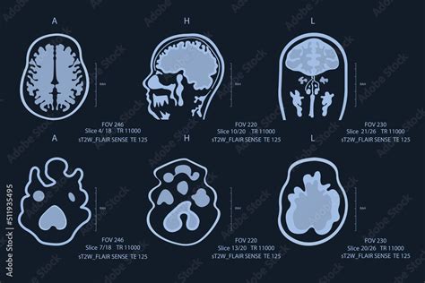 Elderly man brain scan image on MRI magnetic resonance imaging film for neurological medical ...