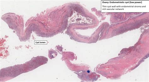 Ovarian Cyst Histology