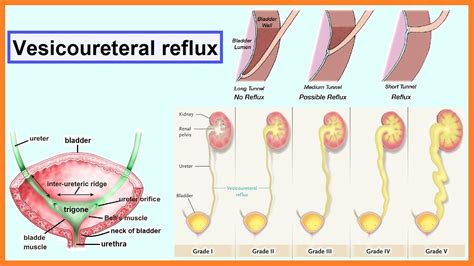 Vesicoureteral Reflux Youtube