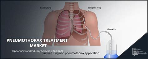 Pneumothorax Treatment