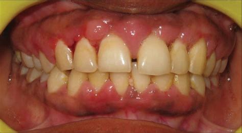 Clinical Appearance Of Amlodipine Associated Gingival Overgrowth