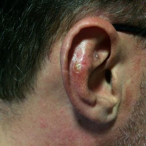 External Ear Tumors