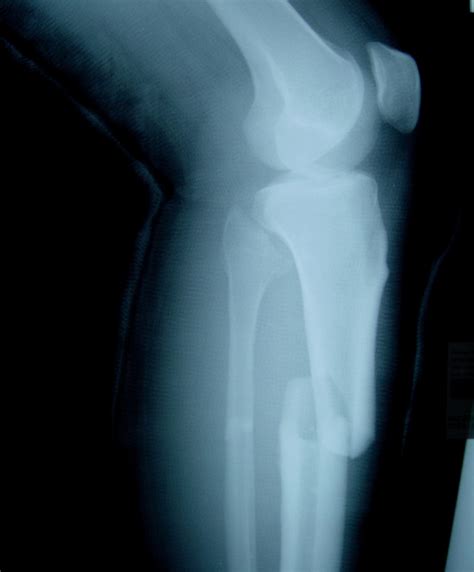 Open Tibia Fracture