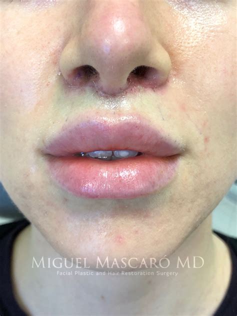 Lip lift overview recovery and before and after – Artofit