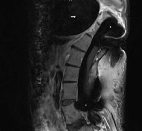 Postoperative axial MRI demonstrates stable left thoracic giant ...