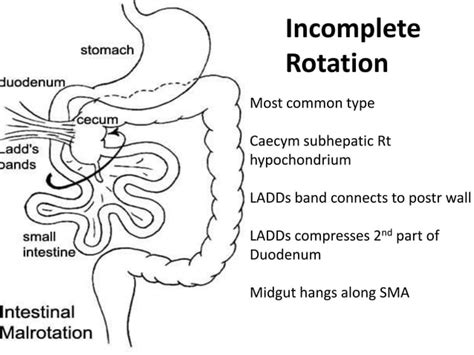 Pathopyshiology Of Intestinal Obstruction Chirantan Mandal Medical College Kolkata