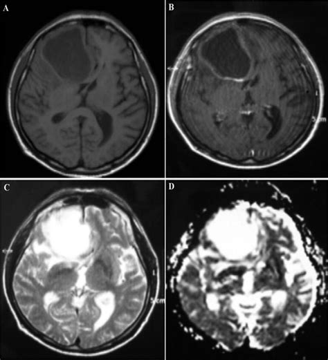 Brain MRI A Plain Axial T1 Weighted Scan Shows A Mass With Low