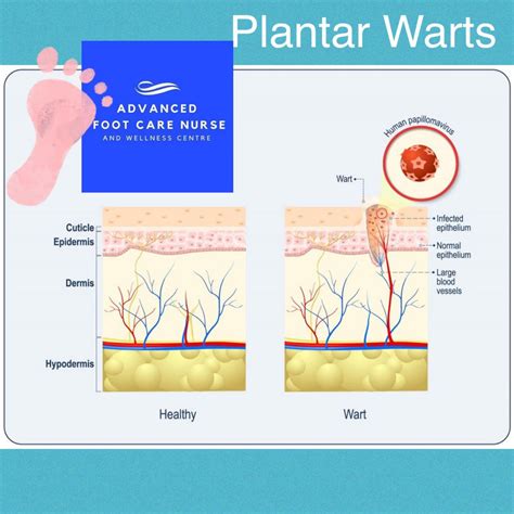 Plantar Wart Handout at Roger Monday blog