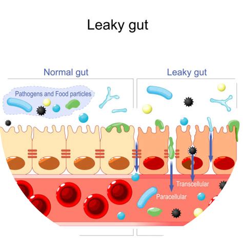 Leaky Gut Syndrome 10 Signs Of Leaky Gut