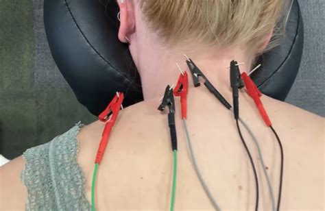 Exploring The Mechanisms Behind Dry Needling Understanding Its