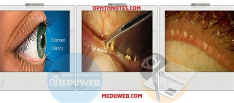 Meibomian gland dysfunction - Meduweb