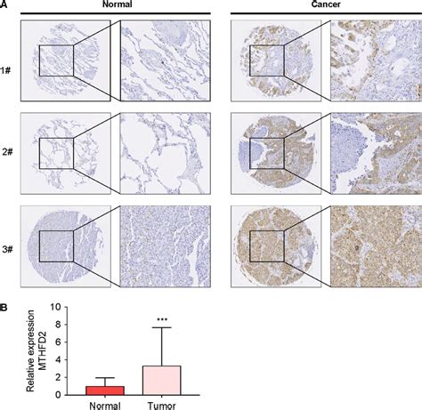 MTHFD2 Is Overexpressed In NSCLC Tissue A Representative