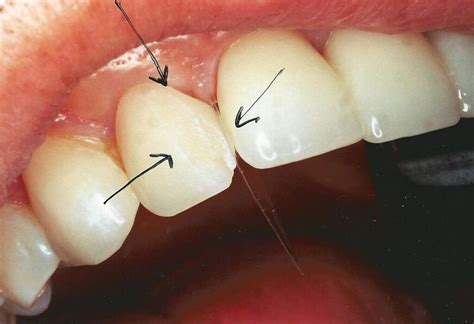 How To Fix A Chipped Veneer Tooth At Home Howtofix One