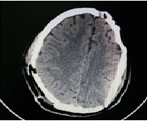 Figure From Intraoperative Contralateral Massive Extradural Hematoma