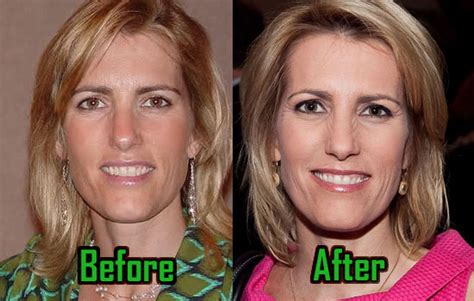 Laura Ingraham: Plastic Surgery for Facelift? Before-After Photos ...