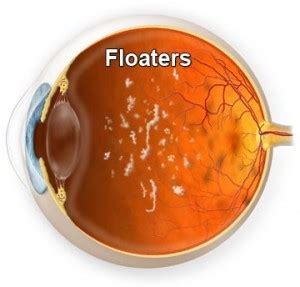 What are Floaters | Treatment of Floaters