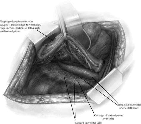 Modern Surgery for Esophageal Cancer | Abdominal Key