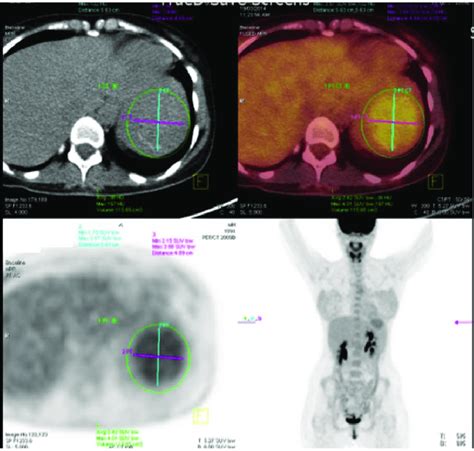 Positron Emission Tomography Computed Tomography Pet Ct Scan Of The