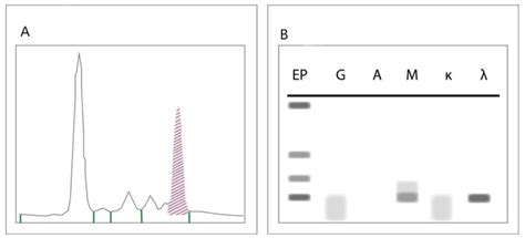 Typical Findings On Serum Electrophoresis Spep A And Immunofixation