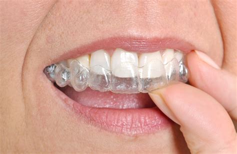 Invisalign Tips You Need To Know