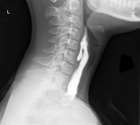 Zenker Diverticulum