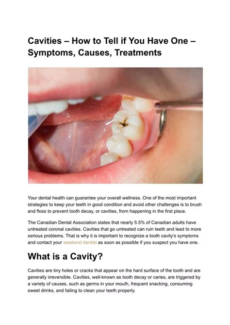 PPT Cavities How To Tell If You Have One Symptoms Causes