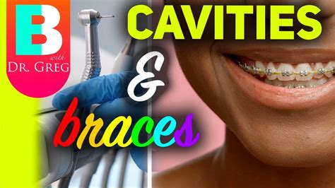 Most Common Cavities With Braces And How To Prevent Them Youtube Dental Decay Cavities How