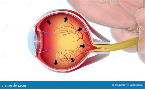 Glaucoma is an Eye Condition that Damages the Optic Nerve, Which is Vital for Good Vision Stock ...