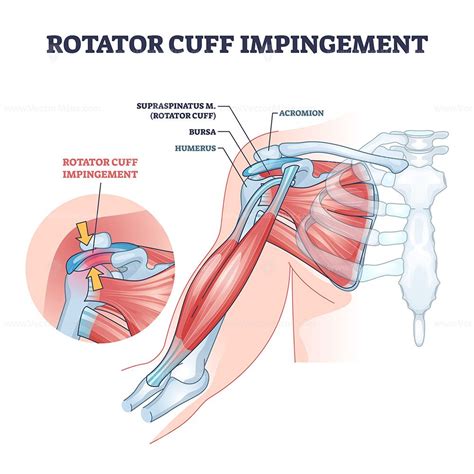 Rotator Cuff Impingement And Anatomical Shoulder Muscle Outline Diagram